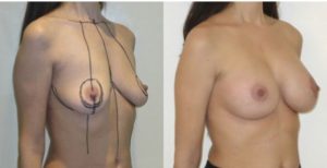 Photo lifting mammaire avec prothèses avant et après