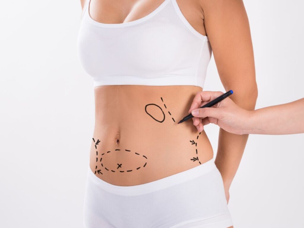 abdominoplastie-en-quoi-consiste-cette-chirurgie-esthetique-pour-avoir-un-ventre-plus-plat